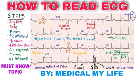 ecg for dummies